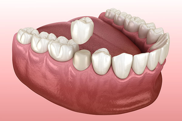 Frequently Asked Questions About Tooth Extraction